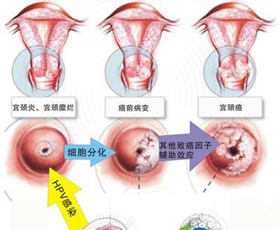 温州宫颈管增生需要手术切除吗?